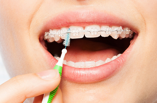 歯の健康を守るためにはセルフケアが重要